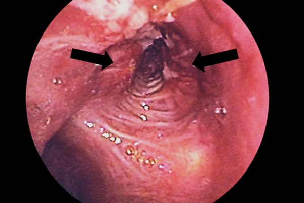 Lung_cancer_in_L._Bronchus_-_bronchoscopic_view.png