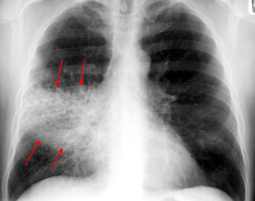 rml-pneumonia-pa1b.jpg