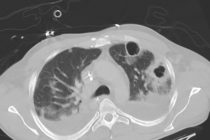 CT_chest_in_pneumonia_with_abscesses_caverns_and_effusions_d02.jpg