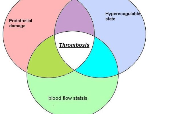 VTE_Pathophysisology_Virchows_triad.jpg