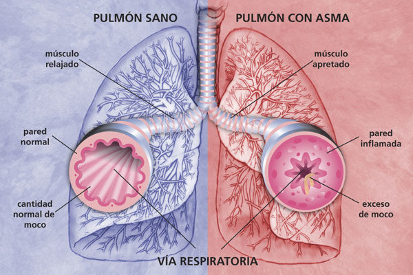 asma_pulmones.jpg